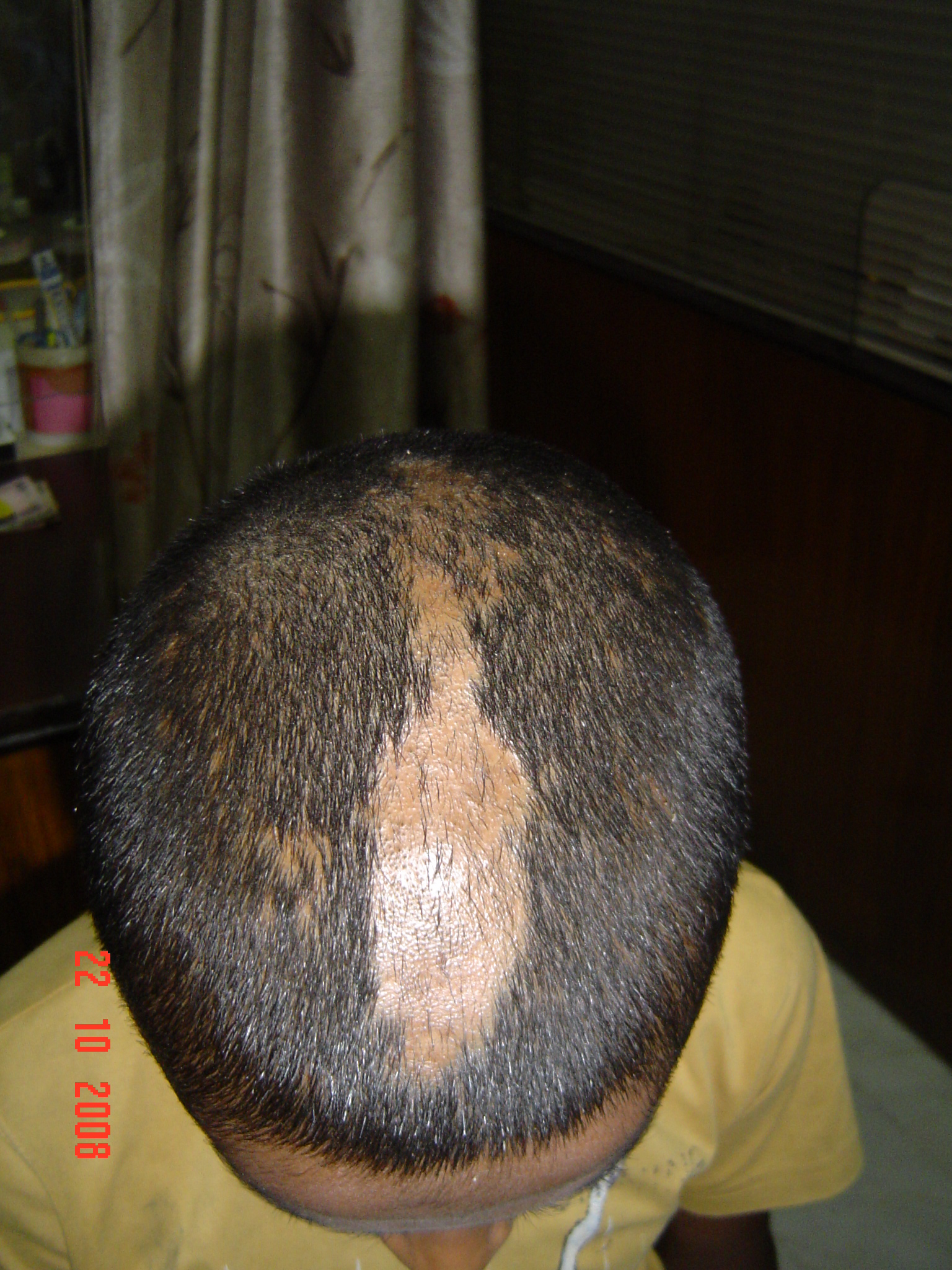 Taenia 5 E 244 MR.NITIN KUMAR 12 YRS.T.CAPITIS22 OCT 08