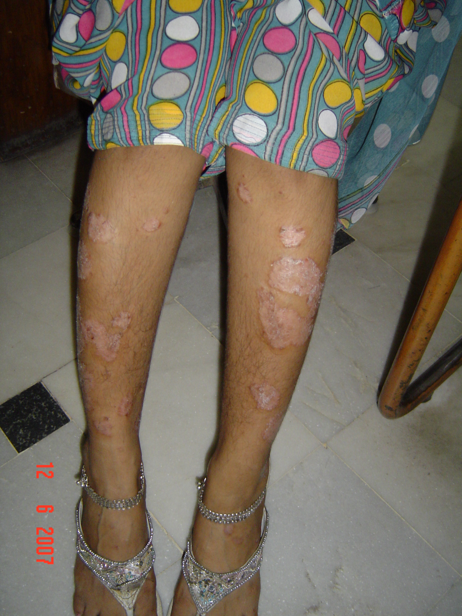 Psoriasis 9 I 373 MRS.PRACHI SAXENA23 YRS.PSORIASISRAMPUR12 6 07