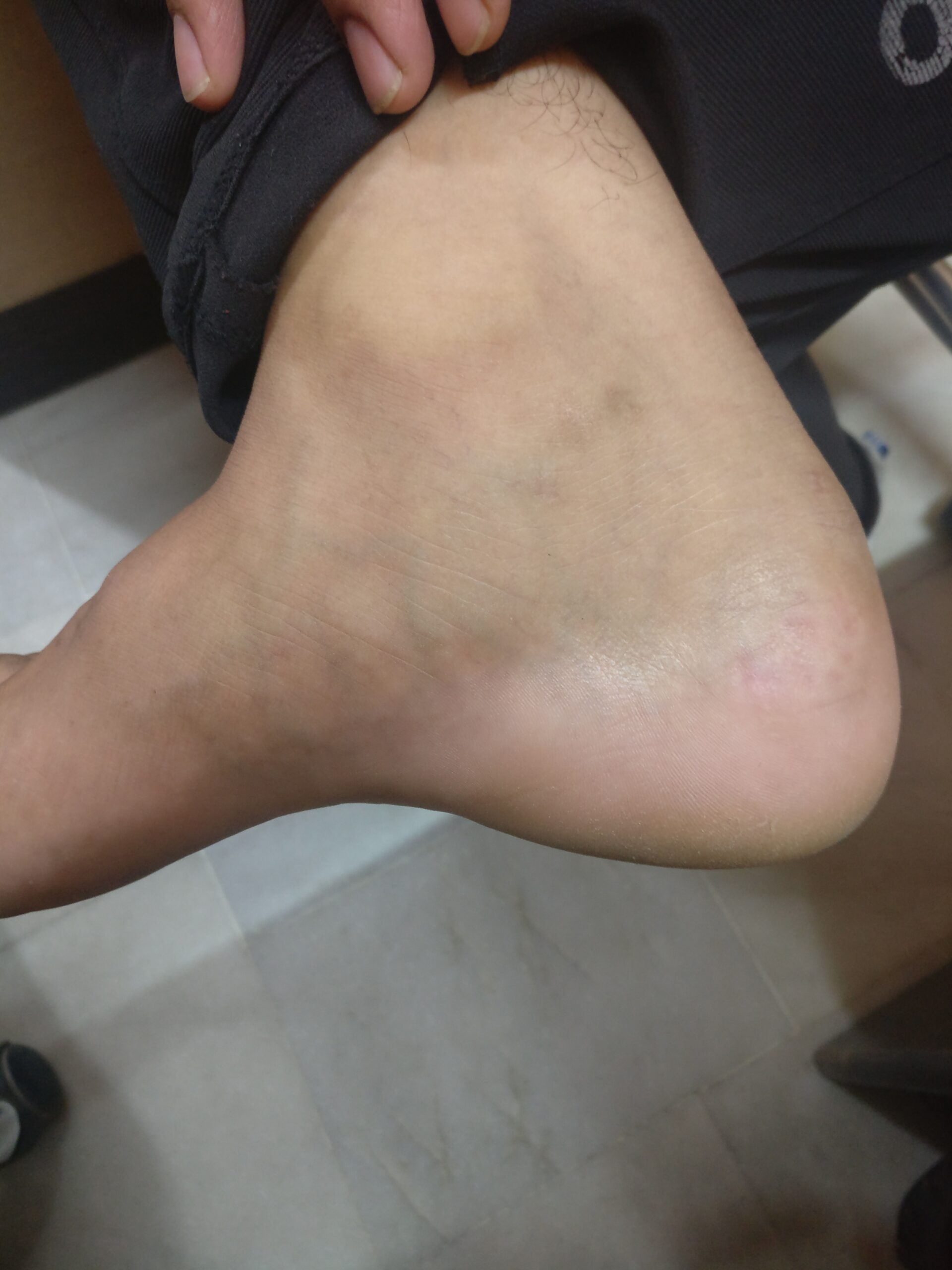 Warts 4 IMG 20190511 134025 scaled