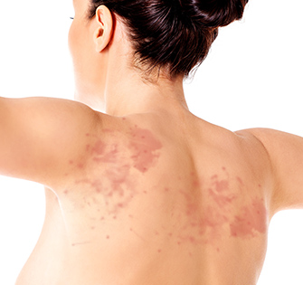Psoriasis 2 Rash