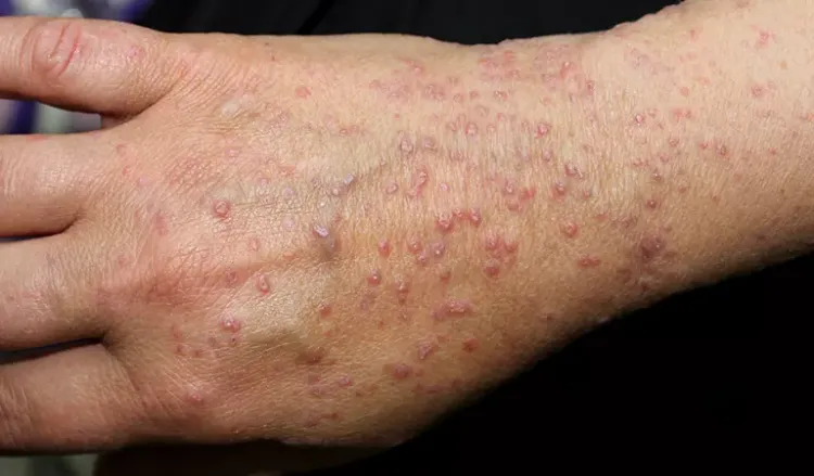 Lichen 2 What is the best lichen planus treatment Image