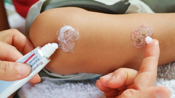 Impetigo 2 impetigo treatment and therapy rm 722x406 1