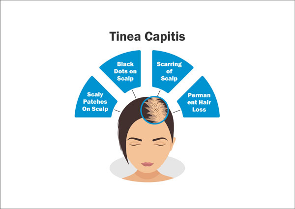 Taenia 1 tinea capitis