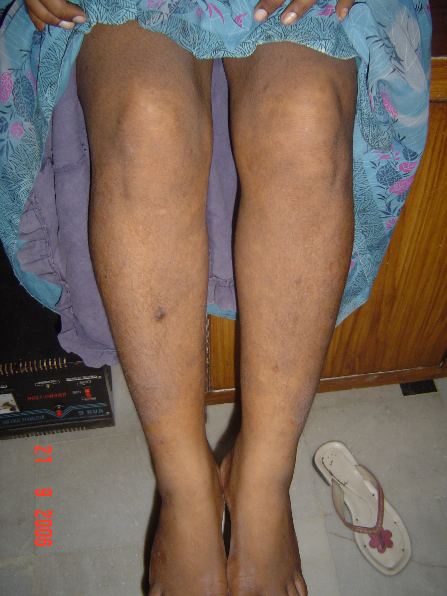 Psoriasis 12 MRS. KUSUM AMROHAPSORIASIS21 11 06