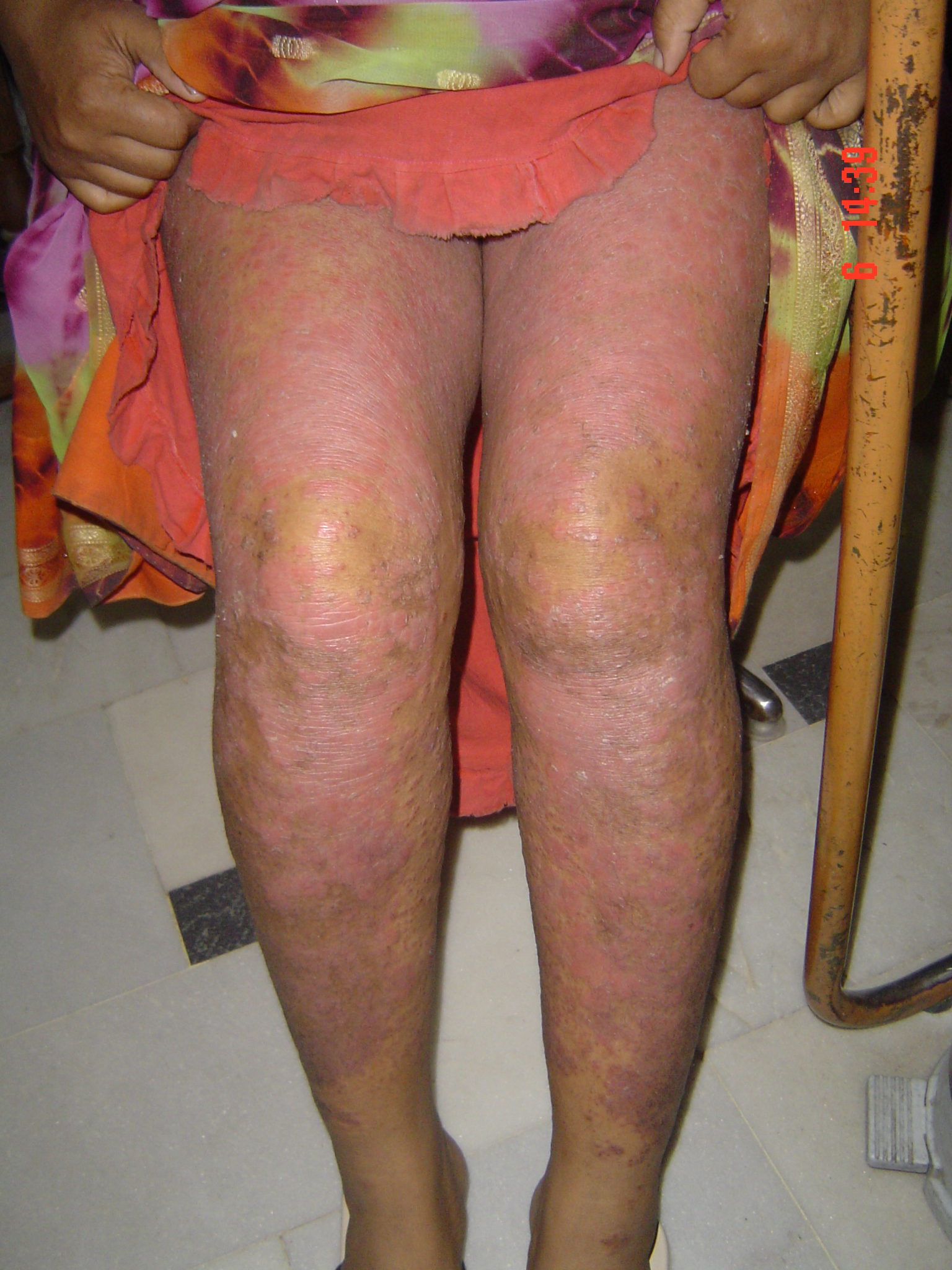 Psoriasis 11 MRS. KUSUM AMROHAPSORIASIS6 2 06