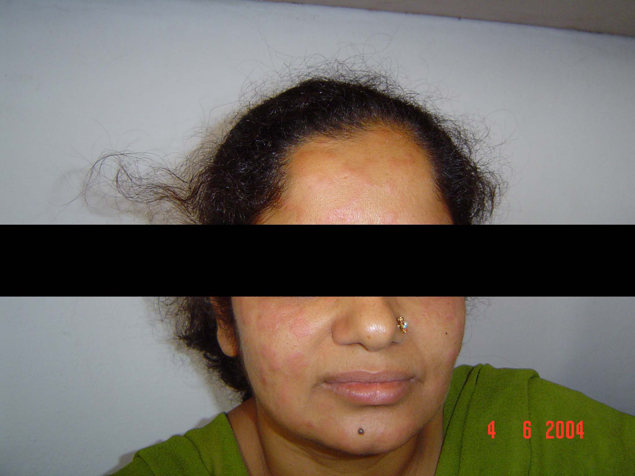 Urticaria 3 MRS. PRITI SHARMA 32 YRS.URTICARIA 4 JUNE 04 1