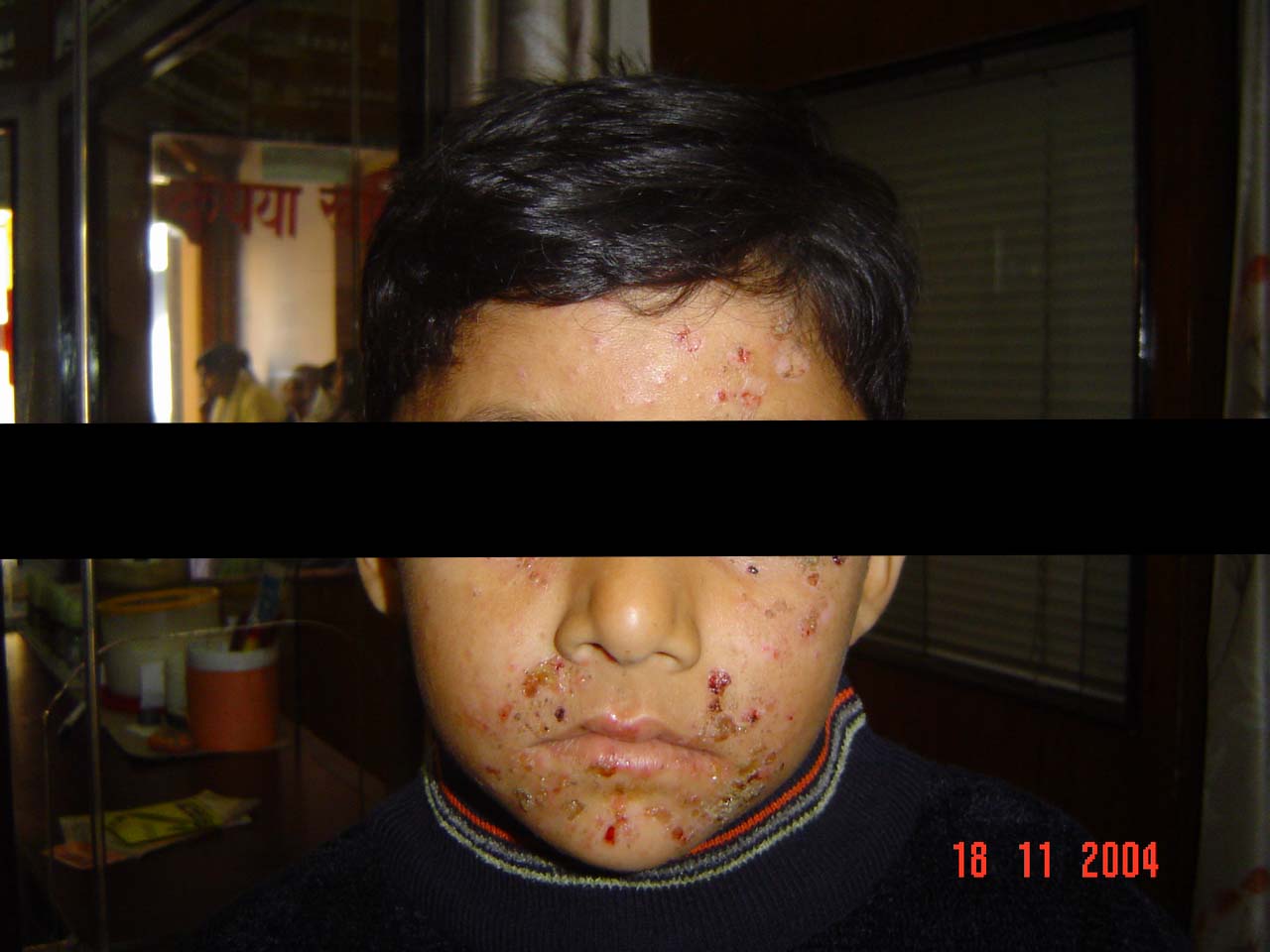 Impetigo 5 WhatsApp Image 2022 08 17 at 4.52.00 PM