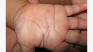 Hand, Foot, and Mouth Disease