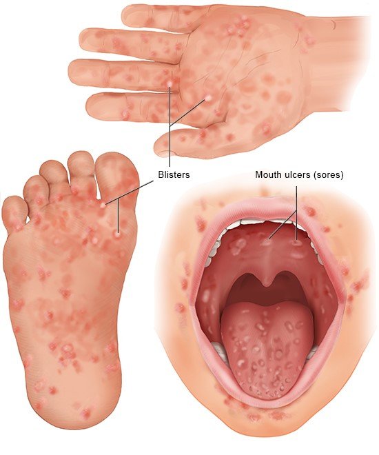 Hand, Foot, and Mouth Disease