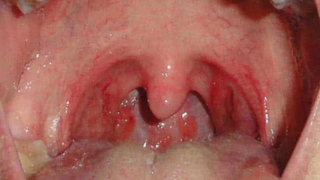 Strep Throat Symptoms