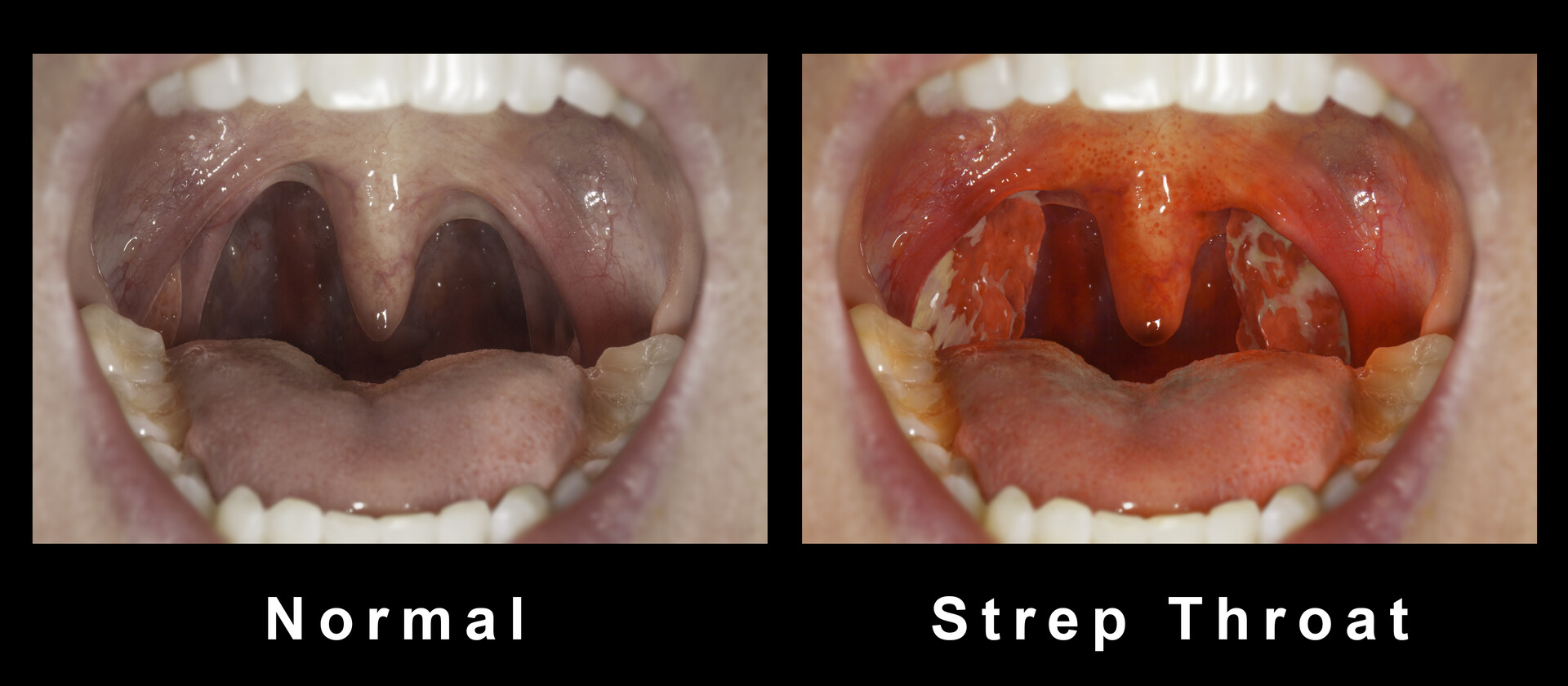Strep Throat
