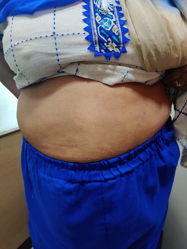 Psoriasis 6 after1 1