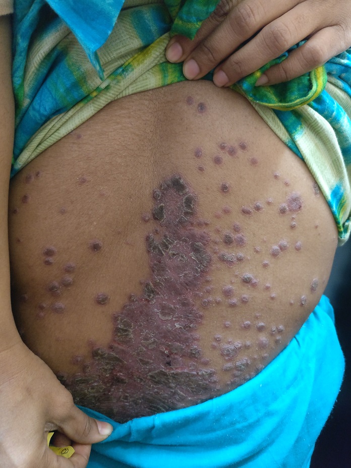 Psoriasis 5 before1 1