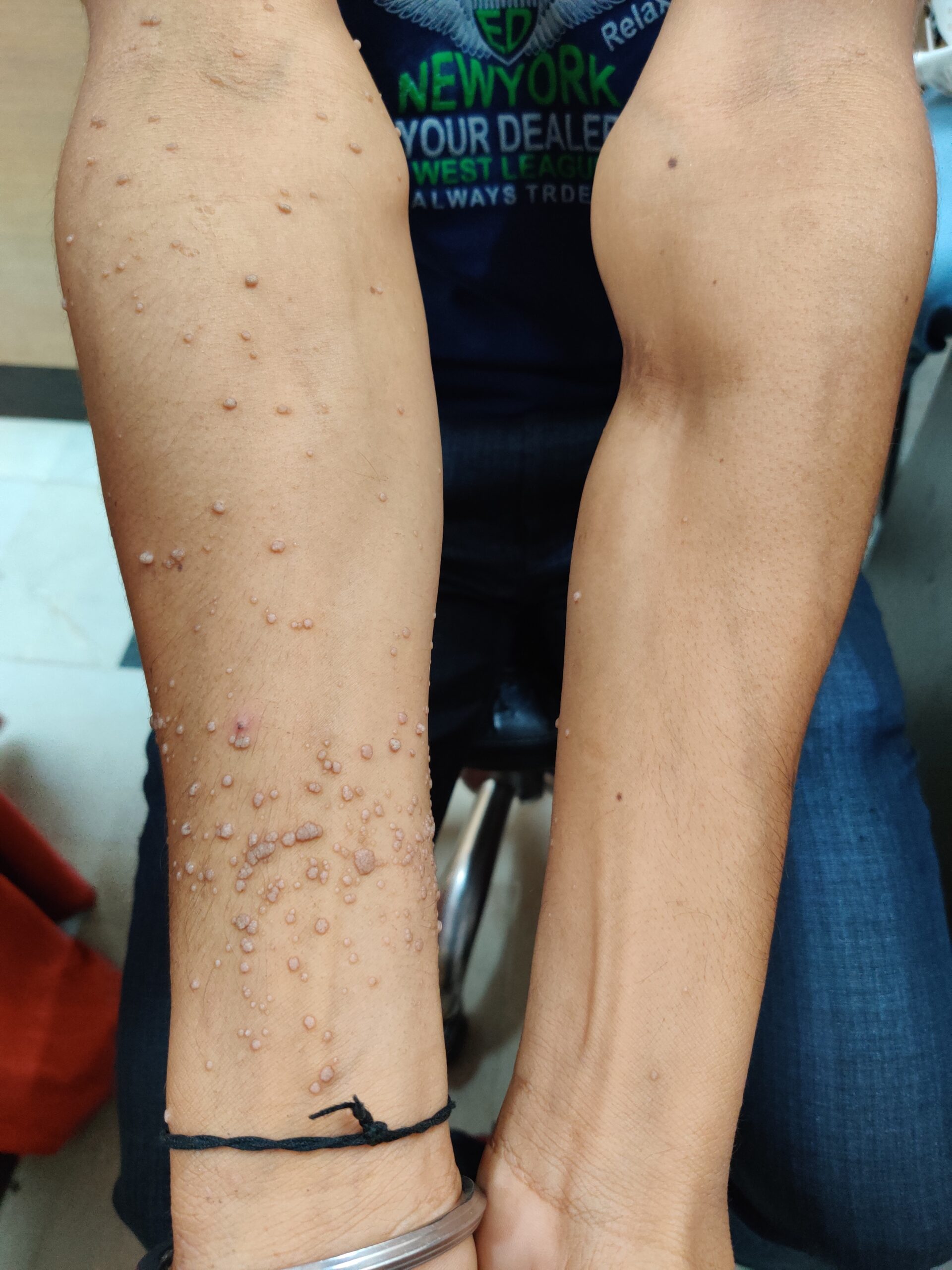 Warts 11 before1 scaled