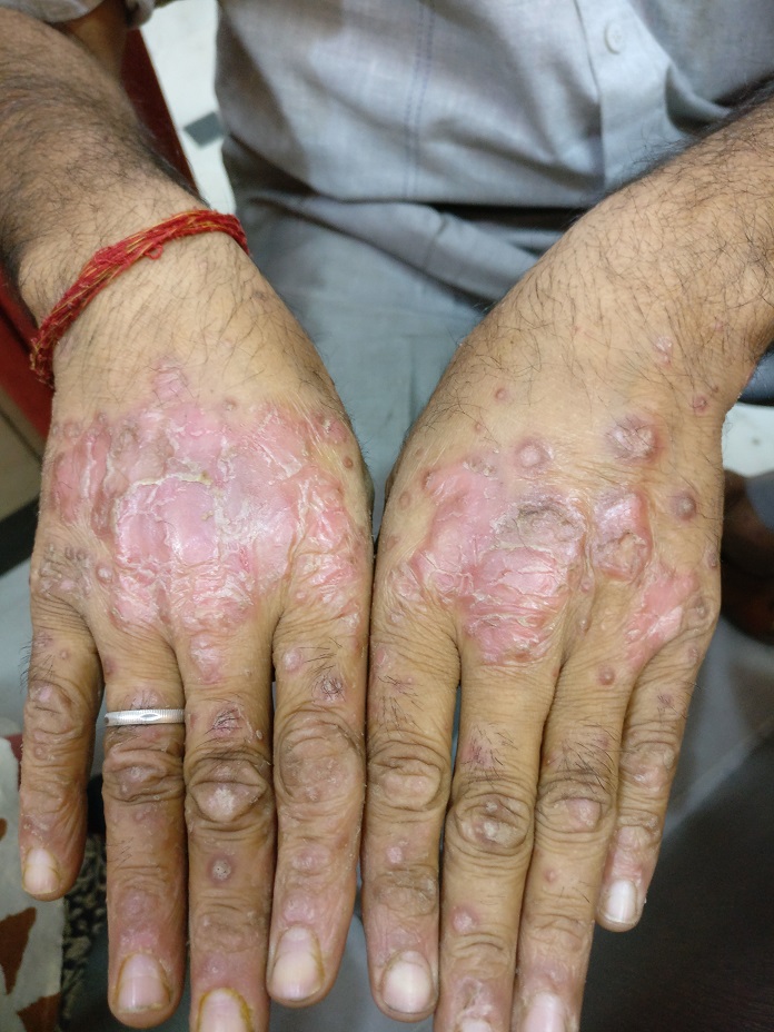 Psoriasis 7 before2