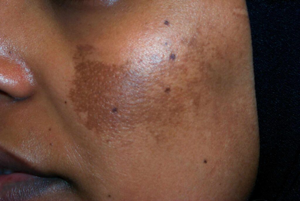 Melasma 1 3133 alt 7cf9740ed8ae46029426504e90c64b0a 1