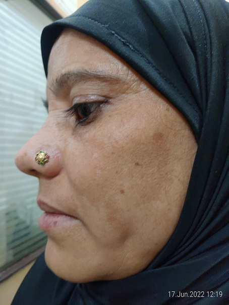 Melasma 4 after 6