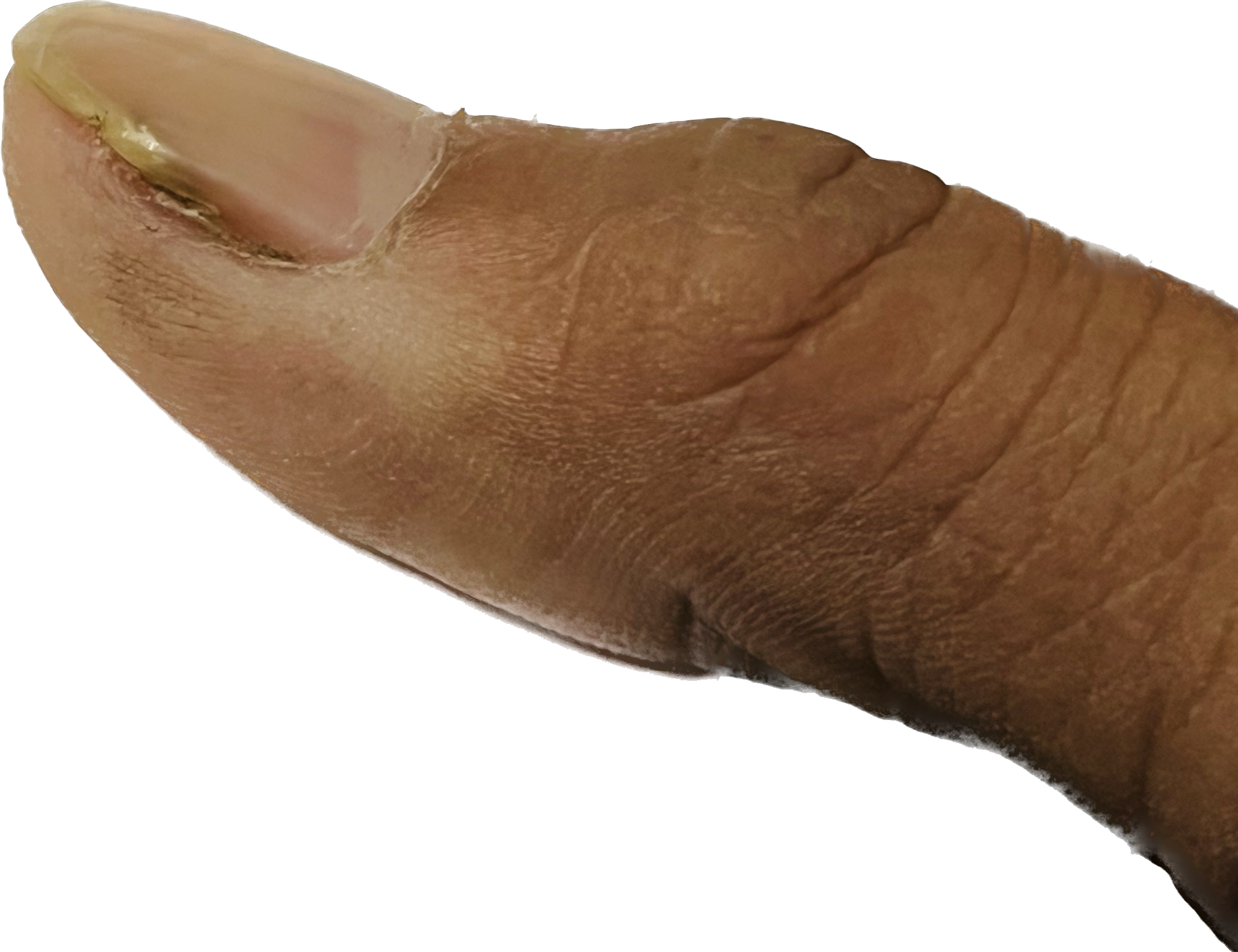 Warts 10 after
