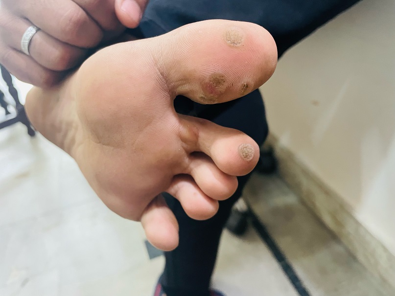 Warts 7 before