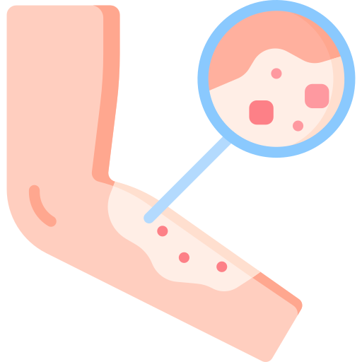 Molluscum Contagiosum